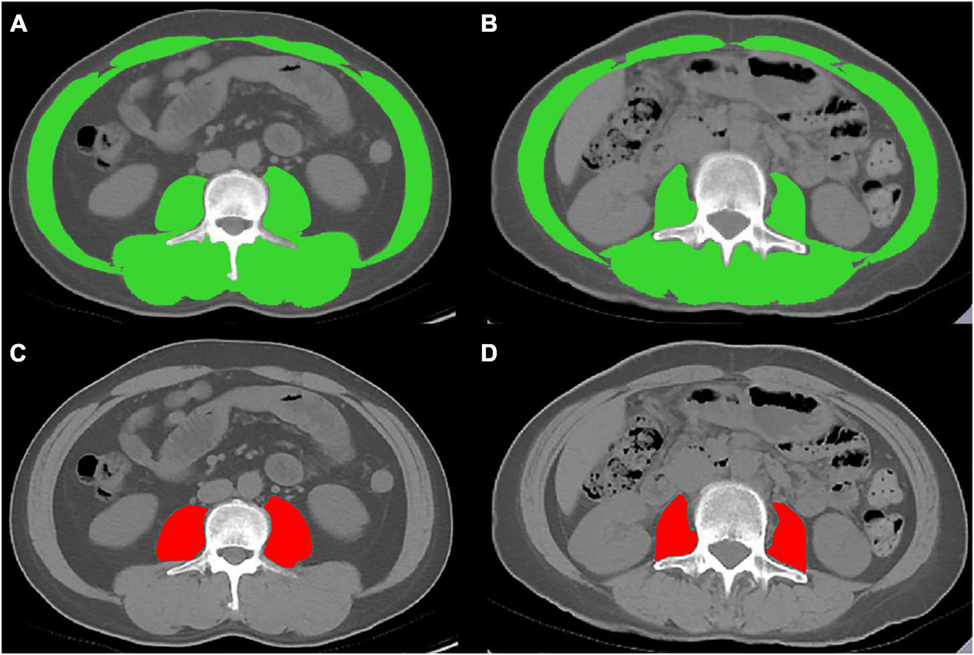 Frontiers Age Specific Reference Values For Low Psoas Muscle Index At