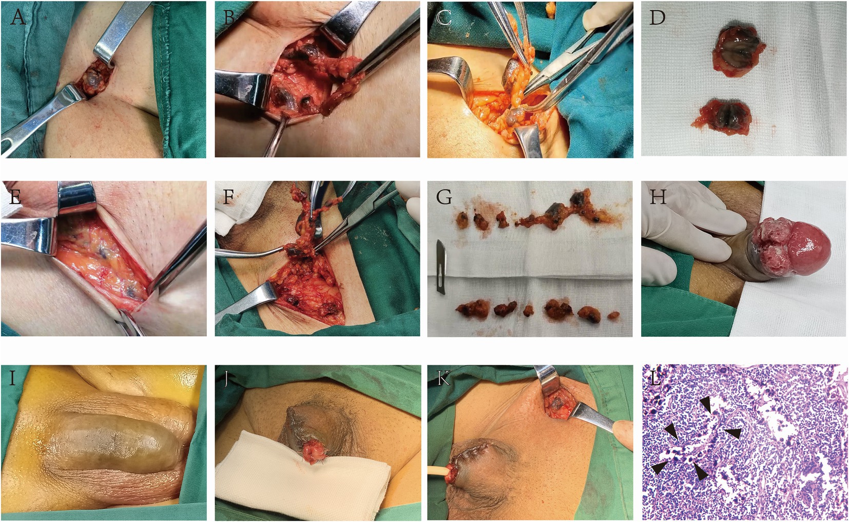 Frontiers Study On Naked Eye Tracing Of Inguinal Sentinel Lymph Nodes In Penile Cancer