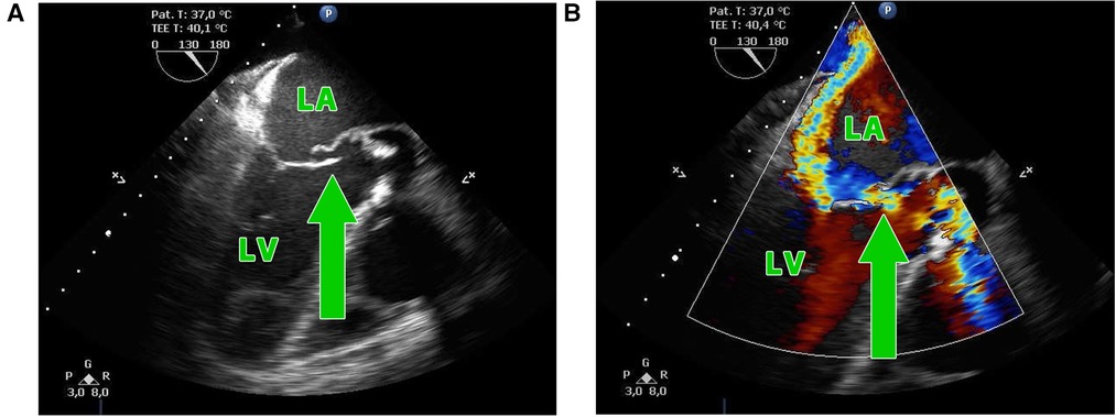 Frontiers Aorto Mitral Curtain Reconstruction In Invasive Double