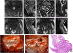 Frontiers Spinal Cavernomas Outcome Of Surgically Treated