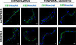 drug-resistant temporal lobe epilepsy alters the expression and