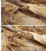 Frontiers An Intrasheath Separation Technique For Nerve Sparing High