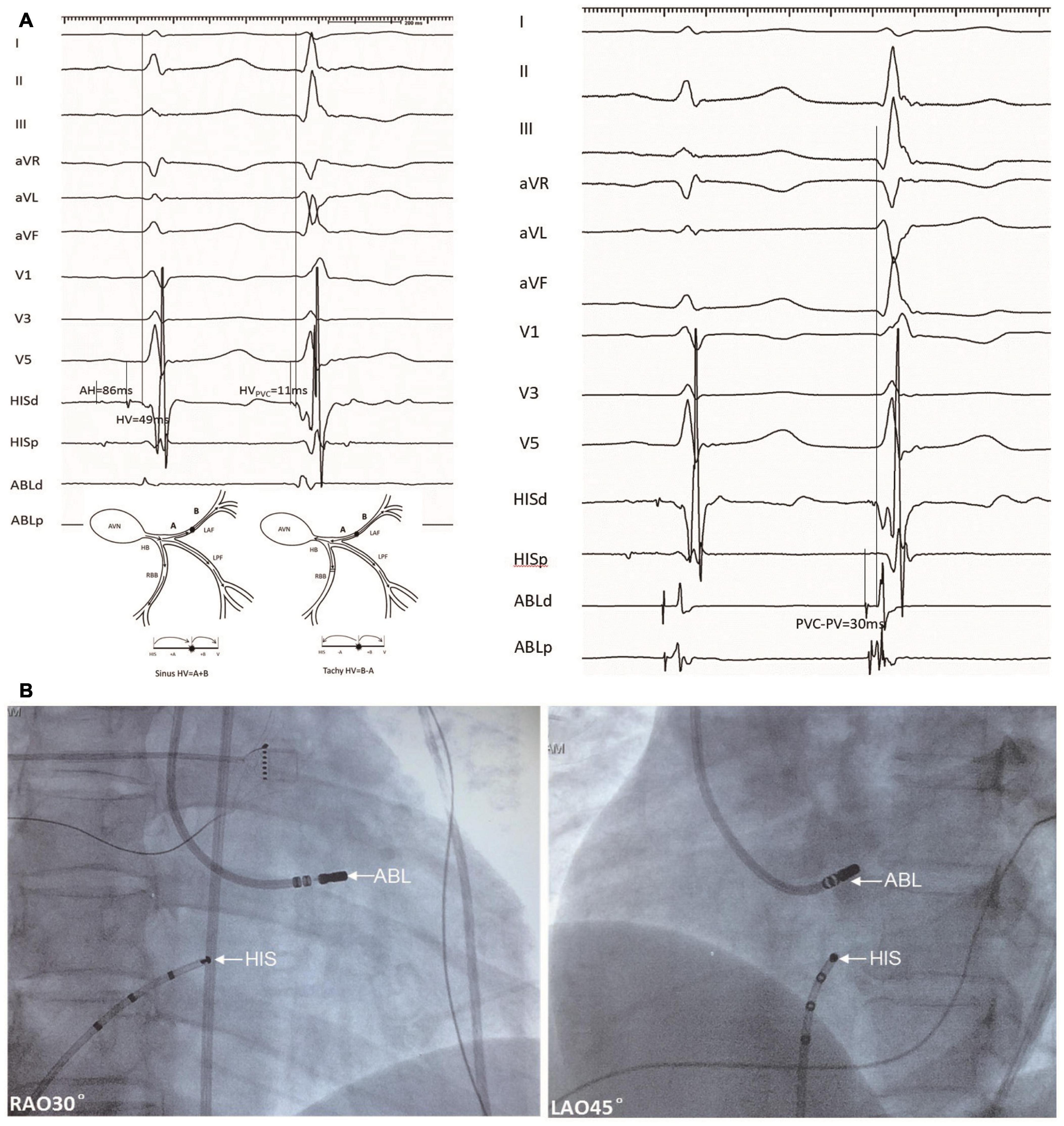 Frontiers Premature Ventricular Contractions From The Left Anterior My XXX Hot Girl