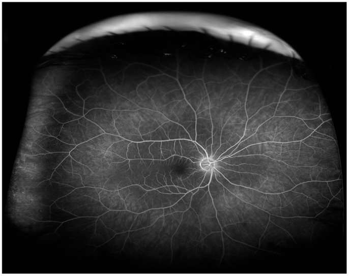 A Short Note On Diabetic Retinopathy Dr