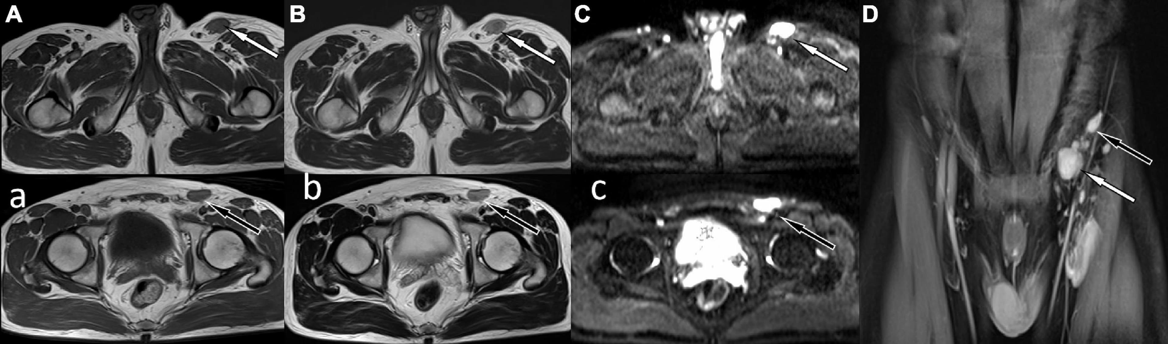 Kimura disease, a rare cause of inguinal lymphadenopathy: A case report -  Frontiers