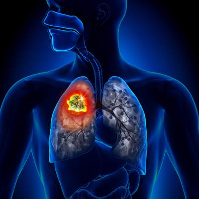 Cover image for research topic "Therapeutic Strategies in EGFR Mutant Lung Cancer"