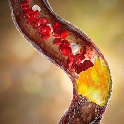 Cover image for research topic "Cardiovascular Diseases in Autoimmune Diseases: Dyslipidemia and vascular inflammation"