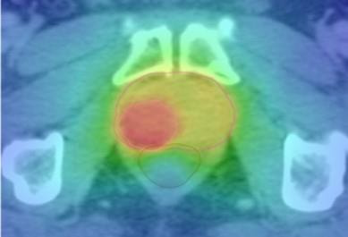 Cover image for research topic "Advances in Radiotherapy for Prostate Cancer"
