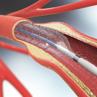 Cover image for research topic "Gastrointestinal and Bilio-Pancreatic Stenting: When, Which Stent and Why"
