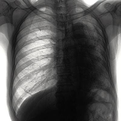 Cover image for research topic "New Molecular Targets Involved in Lung Adenocarcinoma"