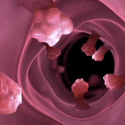 Cover image for research topic "Advances in Genetics and Molecular Diagnosis in Colorectal Cancer."