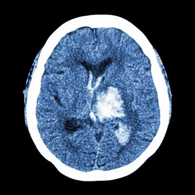 Cover image for research topic "Brain Injury in Spontaneous Intracerebral Hemorrhage: from Bench to Bedside"