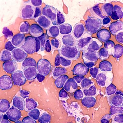 Cover image for research topic "Immunotherapy in Acute Myeloid Leukemia (AML) and Acute Lymphoblastic Leukemia (ALL)"