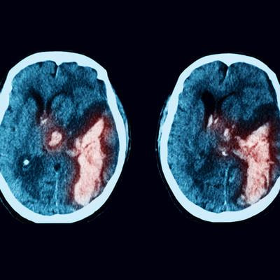 Cover image for research topic "Novel approaches in diagnosis and management of ischemic edema in large vessel occlusion stroke - Volume II"