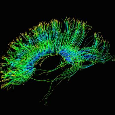 Cover image for research topic "Editor's Challenge: Neuroimaging at the next level - Neuroimaging Methods in Precision Psychiatry"