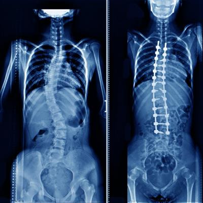 Cover image for research topic "Adolescent Idiopathic Scoliosis: Advances and new Perspectives"