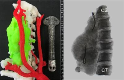 Cover image for research topic "Advances in Surgical Treatment of Primary Spinal Tumors"