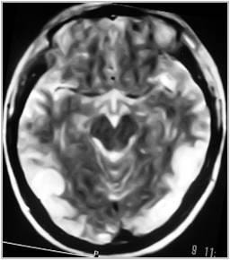 Cover image for research topic "Posterior Reversible Encephalopathy Syndrome and Associated Diseases"