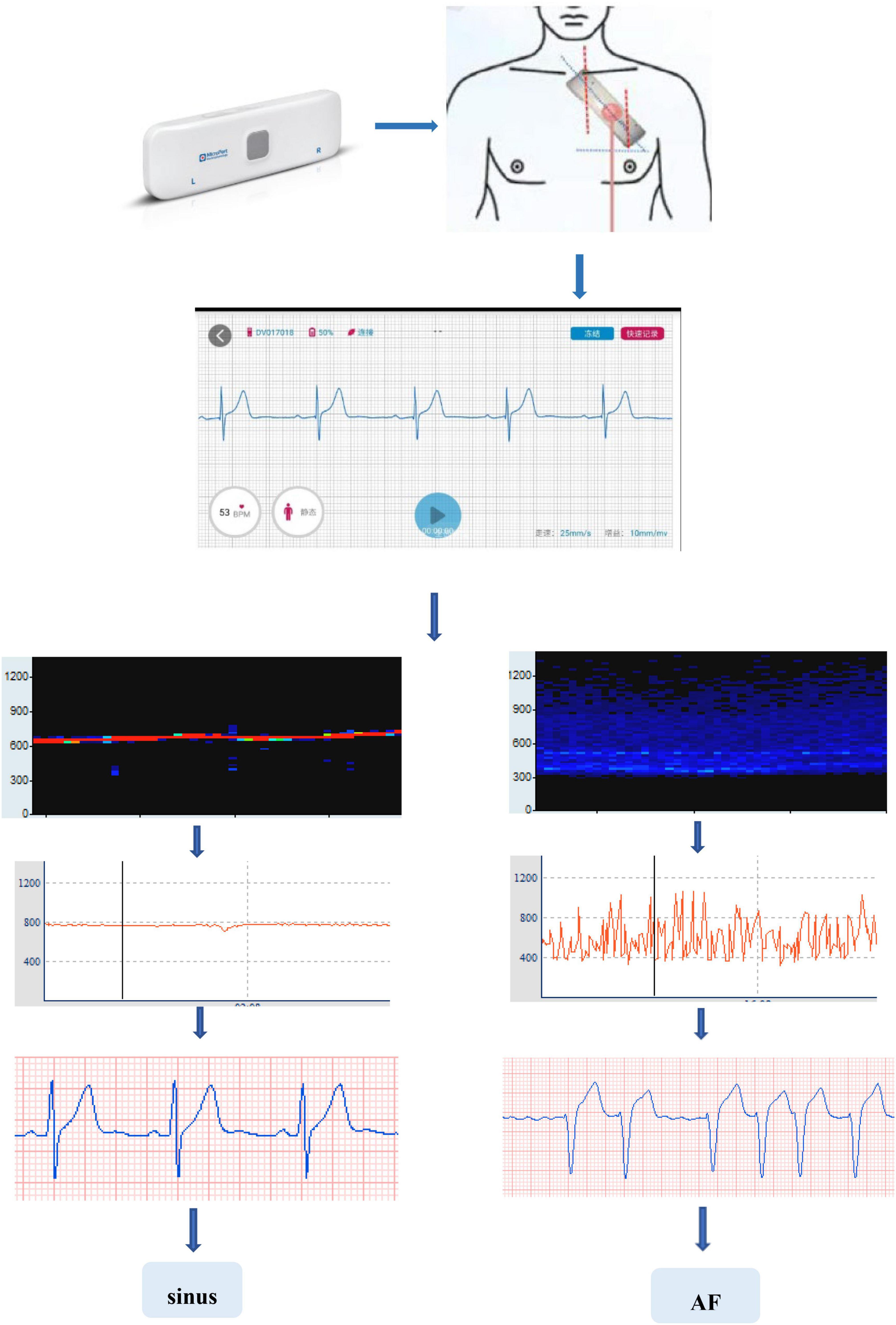 Frontiers Long term Single lead Electrocardiogram Monitoring To 