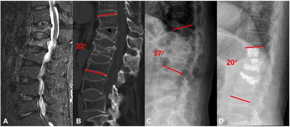 Spinal Compression Fractures  Advanced Orthopaedics & Sports