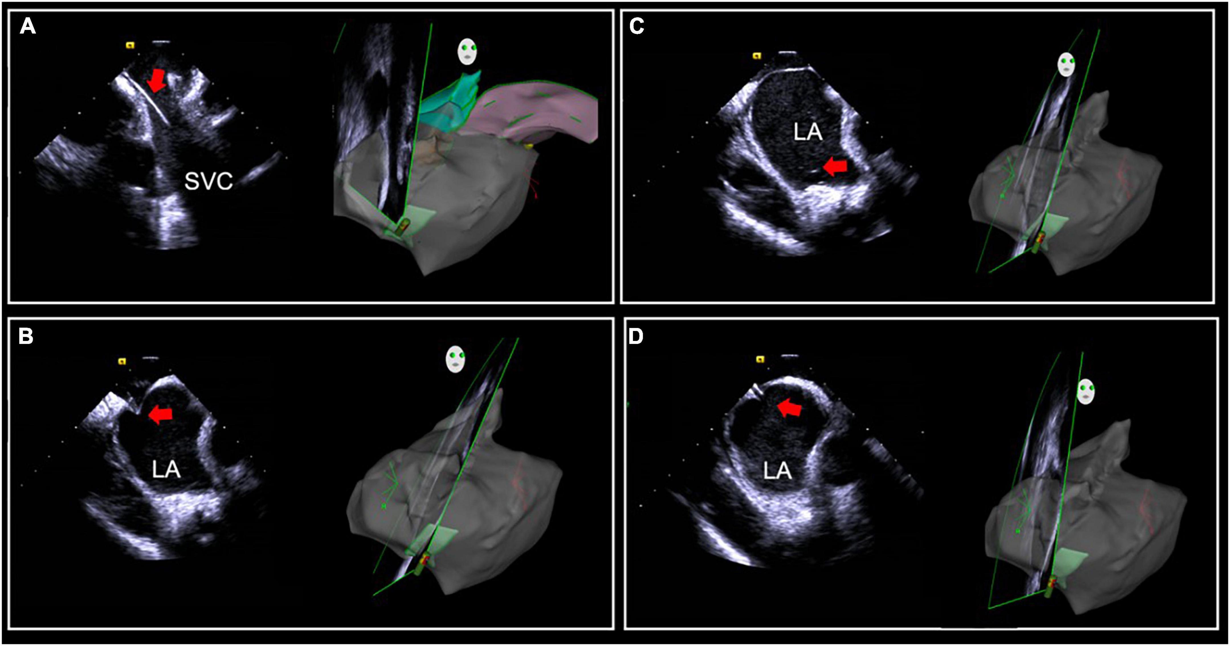 Eccentric Activation Patterns in the Left Ventricular Outflow Tract during  Idiopathic Ventricular Arrhythmias Originating From the Left Ventricular  Summit