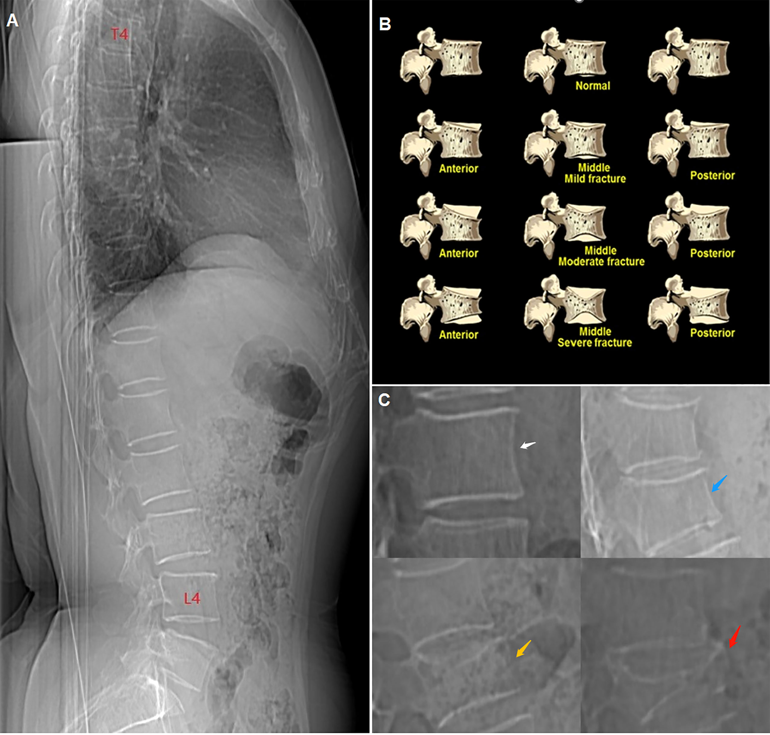 Frontiers  Differences in spine volumetric bone mineral density between  grade 1 vertebral fracture and non-fractured participants in the China  action on spine and hip status study