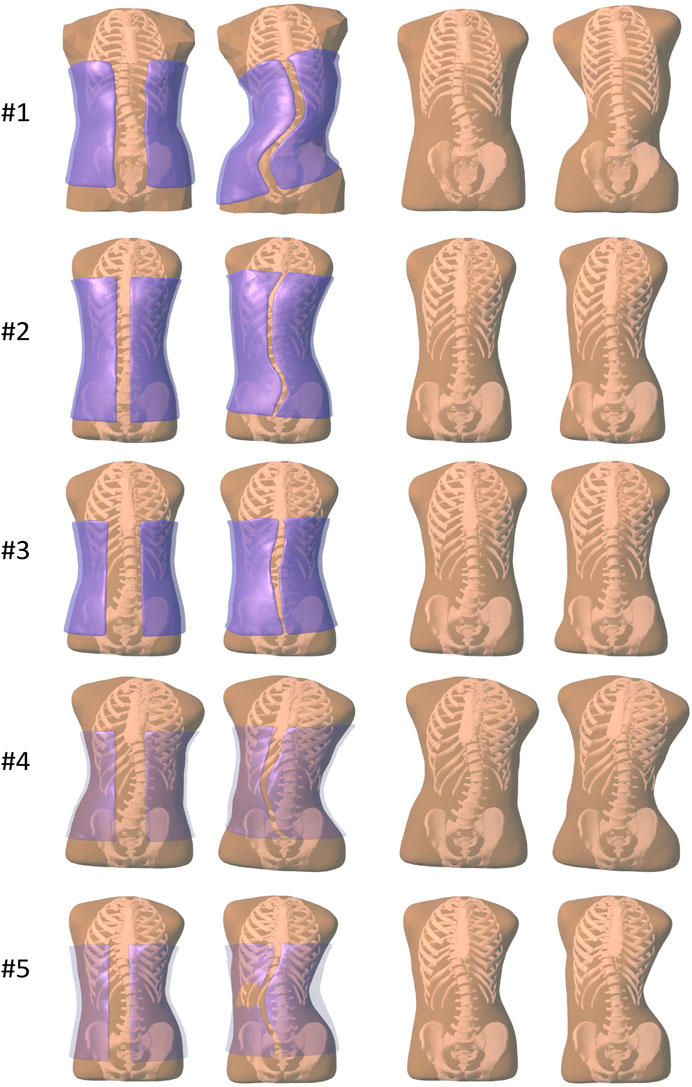 A brace to address functional 4-curve patterns for right thoracic and