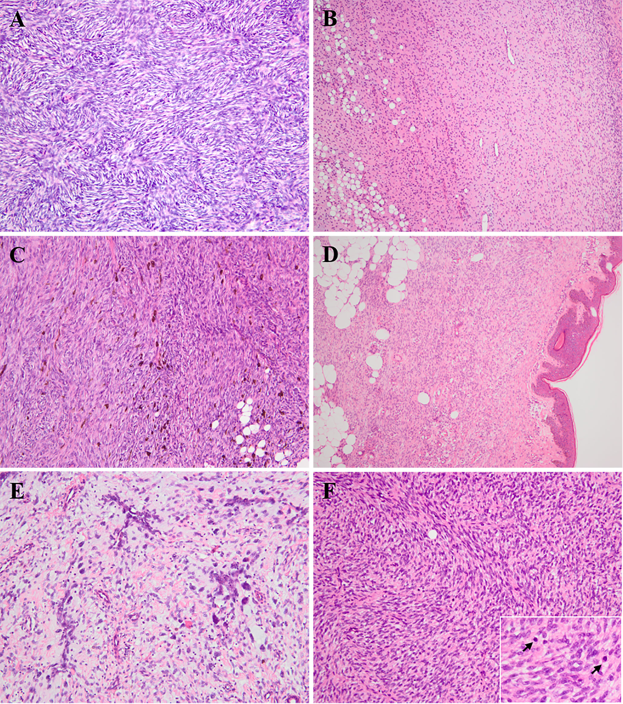 Frontiers  Pediatric dermatofibrosarcoma protuberans: A clinicopathologic  and genetic analysis of 66 cases in the largest institution in Southwest  China