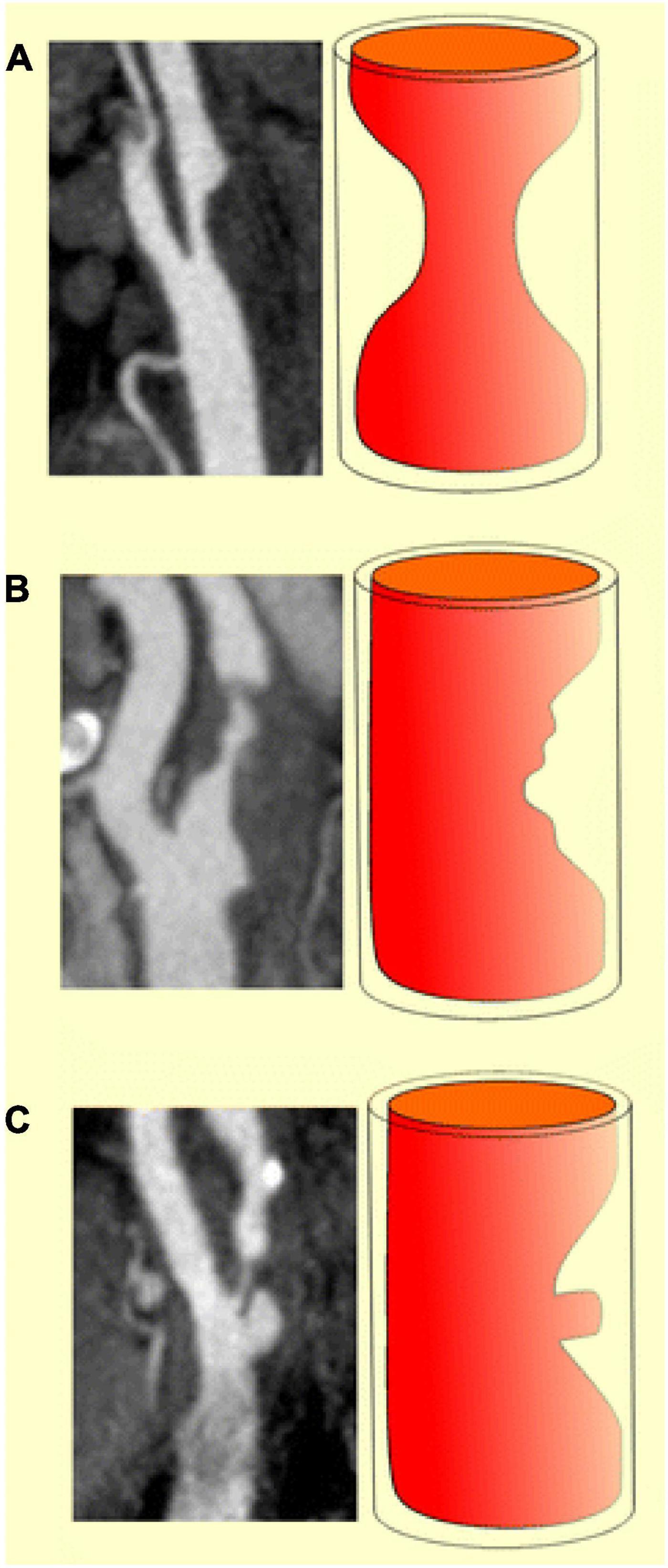 Ameen Ameen Sex Video - Frontiers | The utility of ultrasound and computed tomography in the  assessment of carotid artery plaque vulnerabilityâ€“A mini review