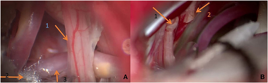 Patient affected with a right vago-glossopharyngeal