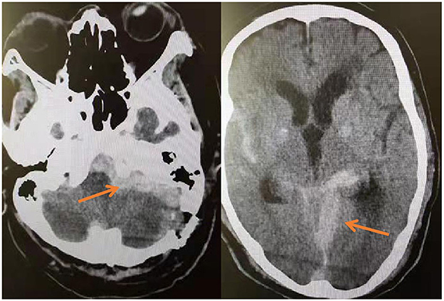 Patient affected with a right vago-glossopharyngeal