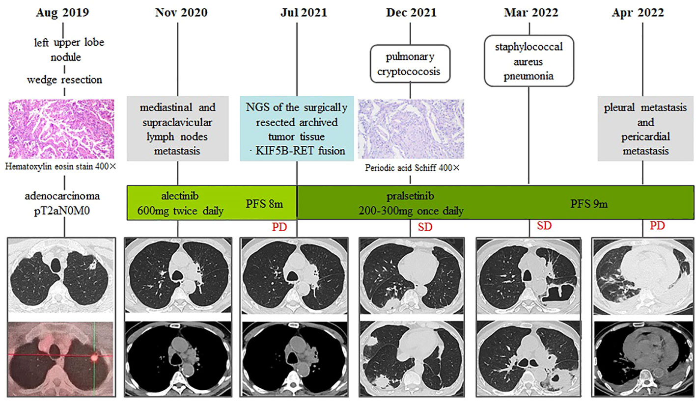 Frontiers Case Report Recurrent Lung Infections Following Treatment 