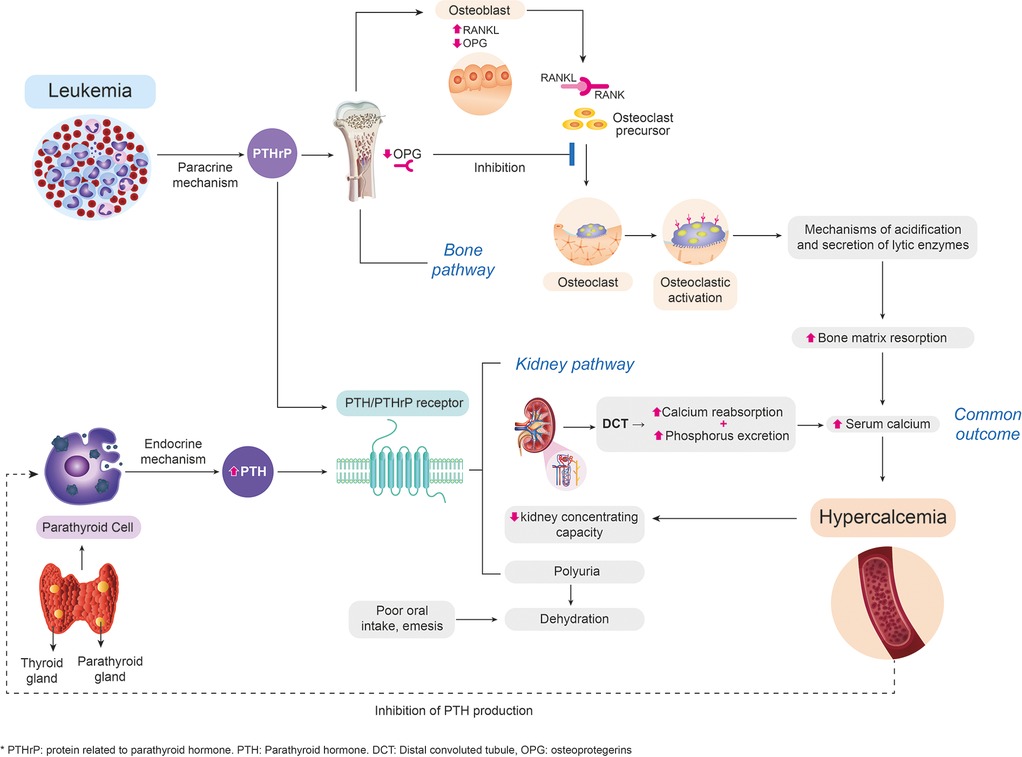 Frontiers | Malignant hypercalcemia as the debut of acute lymphoblastic ...