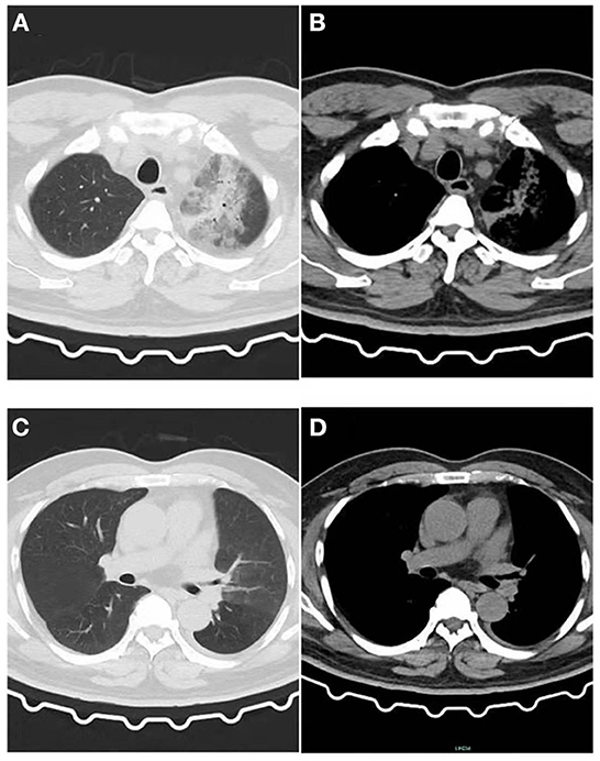 Frontiers Case Report A Chlamydia Psittaci Pulmonary Infection Presenting With Migratory 9930