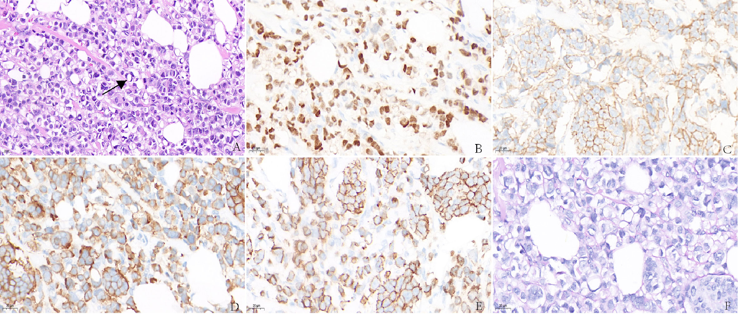 frontiers-her-2-positive-primary-neuroendocrine-neoplasms-of-the