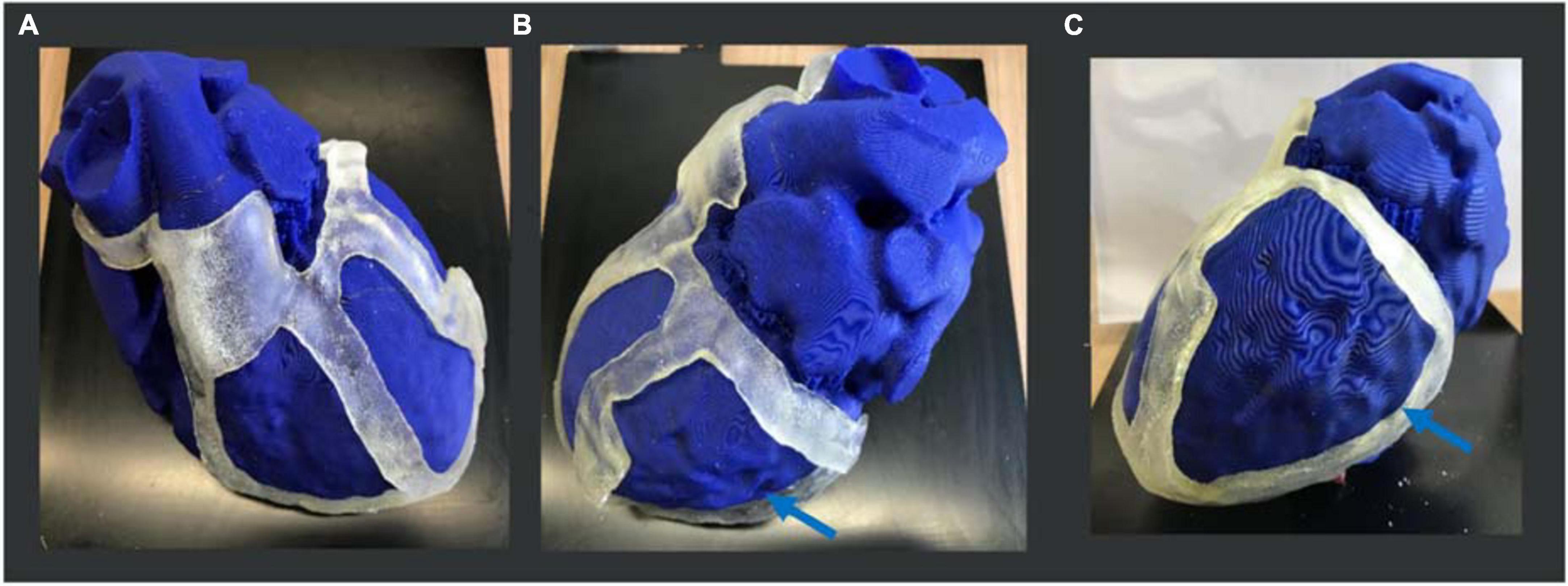 Frontiers | A 3D-printed surgical guide for ischemic scar 