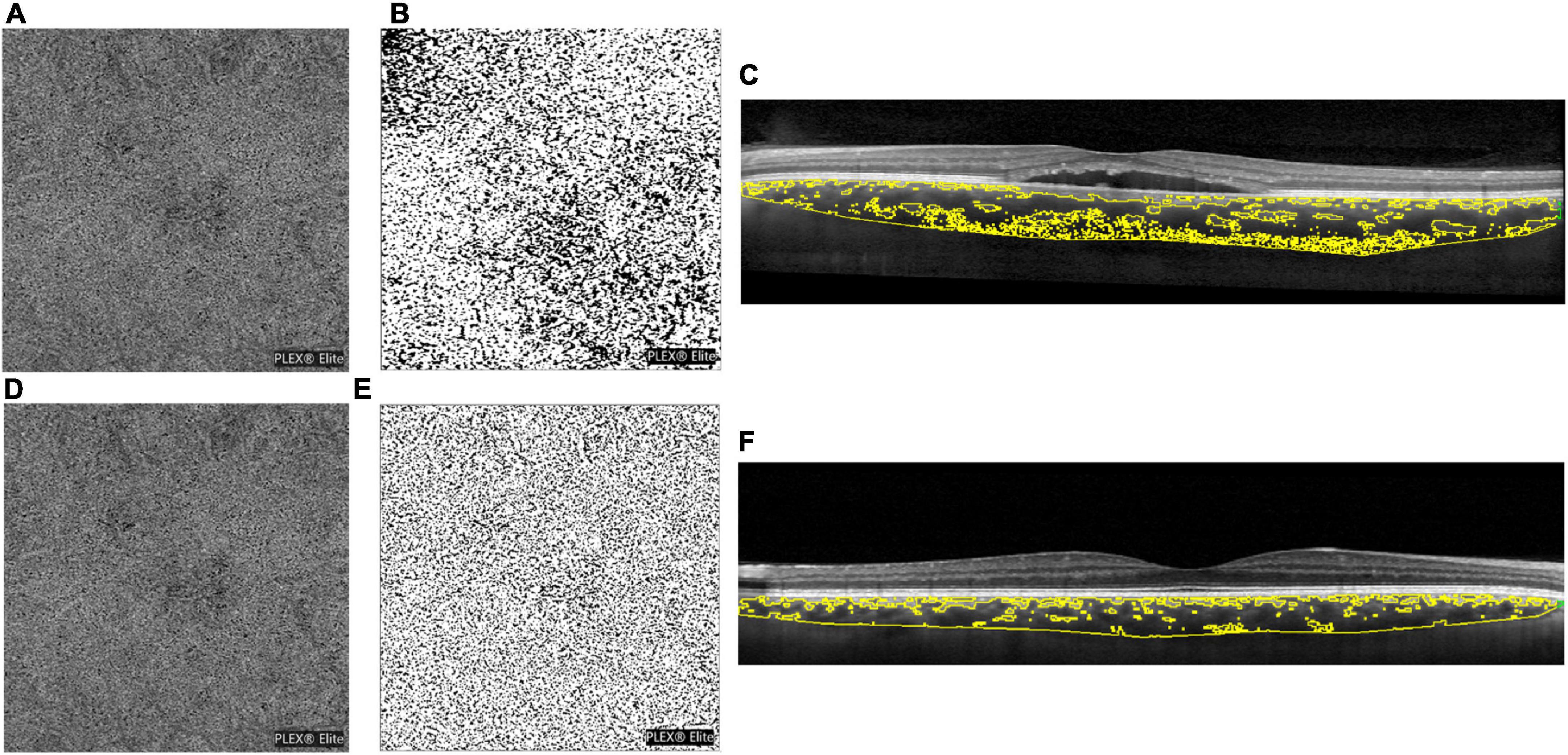 Amy Andresa Sex Video - Frontiers | Cortisol awake response imbalance as an indicator of acute  central serous chorioretinopathy: Relationship with choriocapillaris and  choroidal features