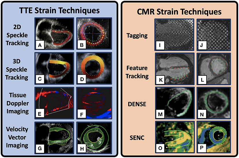 Two-dimensional Echocardiographic Assessment of Myocardial Strain