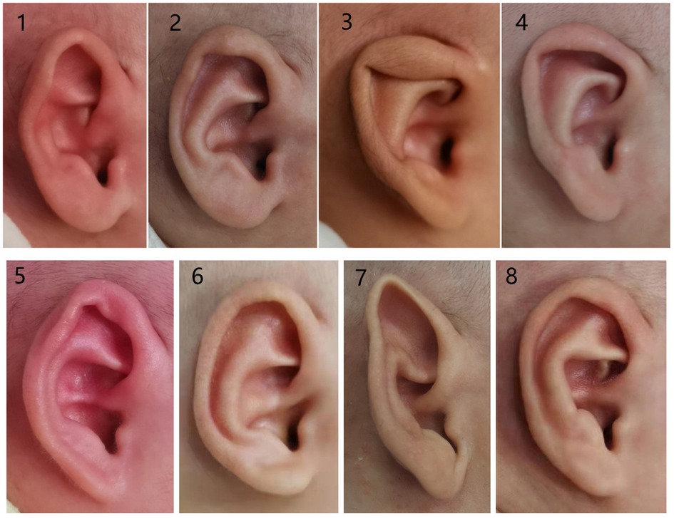 Sound Options: Treating Abnormal Ear Shape in Infants and Children 