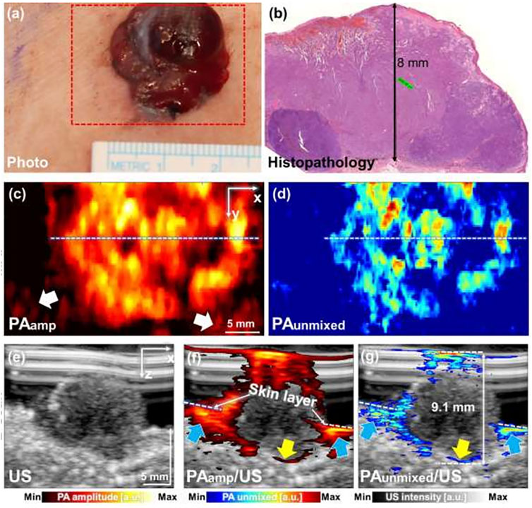 Frontiers  Clinical photoacoustic/ultrasound dual-modal imaging