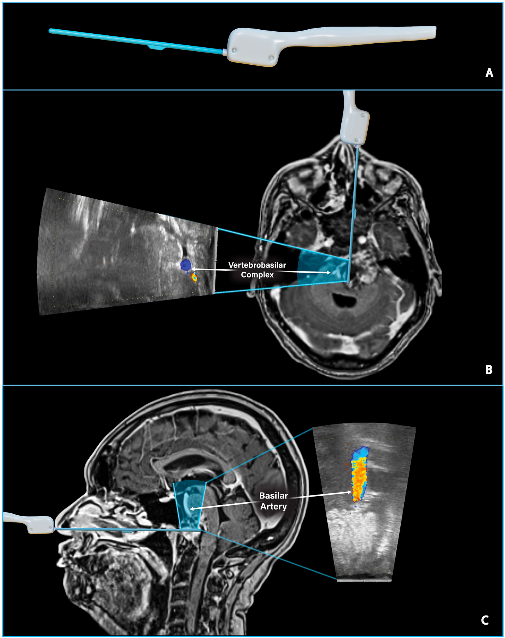 Frontiers Case Report Side Firing Intraoperative Ultrasound Guided Endoscopic Endonasal