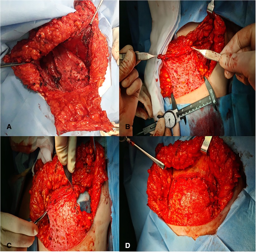 Frontiers  Superomedial pedicle skin-reducing mastectomy in