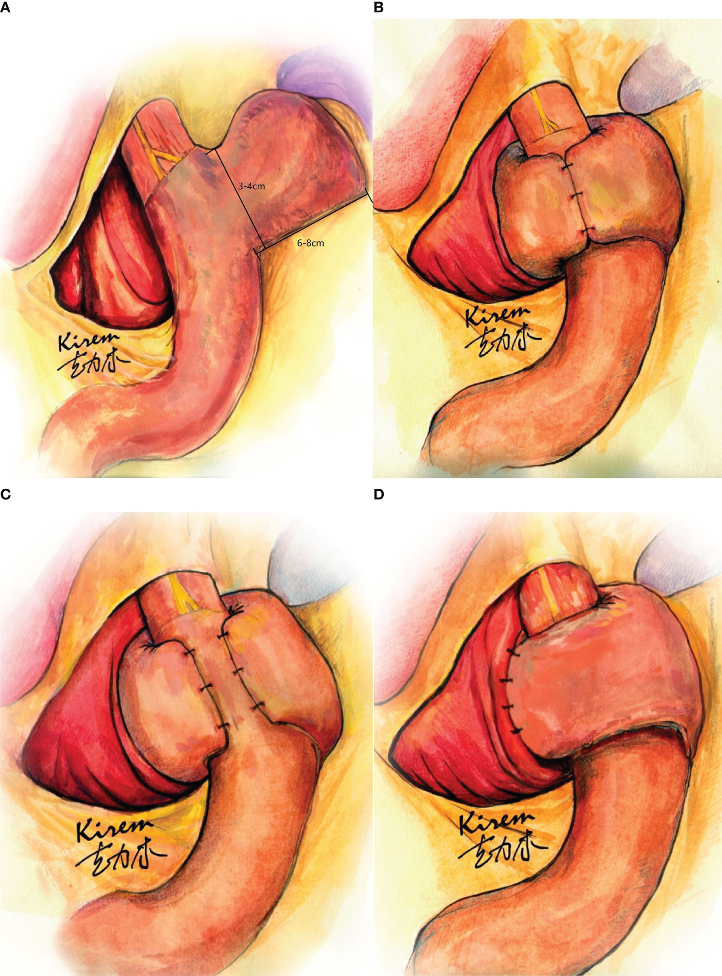 Reflux After Sleeve Gastrectomy - Bariatric Surgery