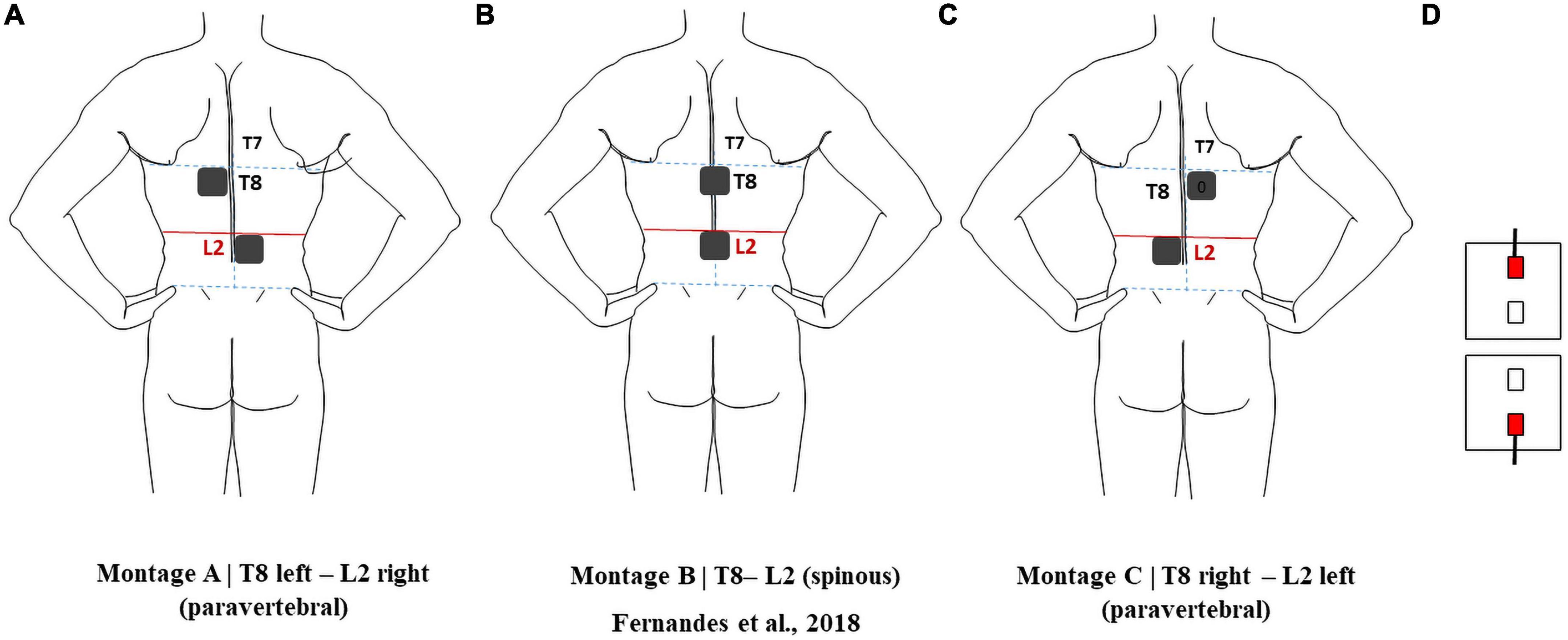 Male Left Cervical Dorsal Column Stimulator Battery Replacement