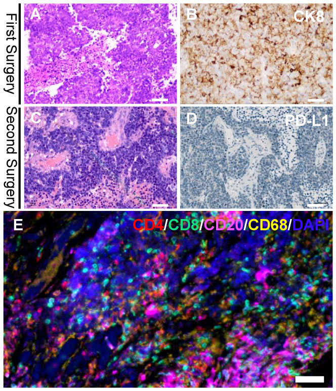 Frontiers | Unexpected Curative Effect Of PD-1 Inhibitor In Gastric ...