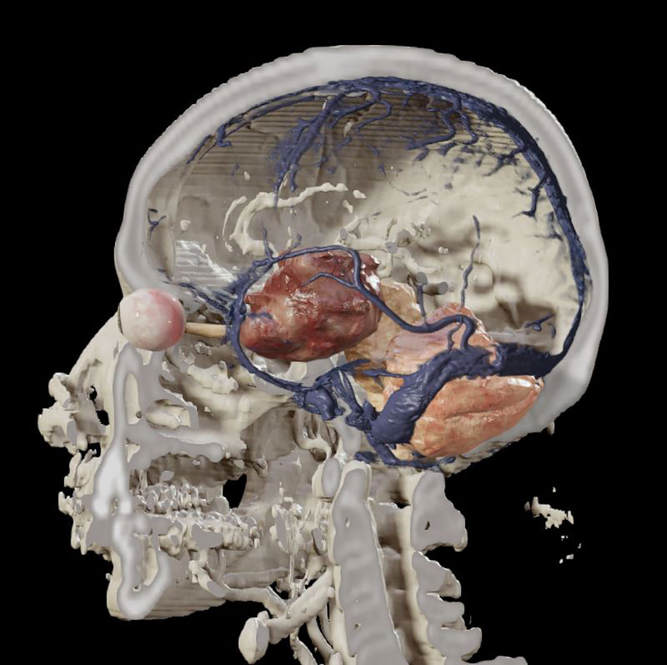 Frontiers | Editorial: Endoscopic transorbital surgery for skull 