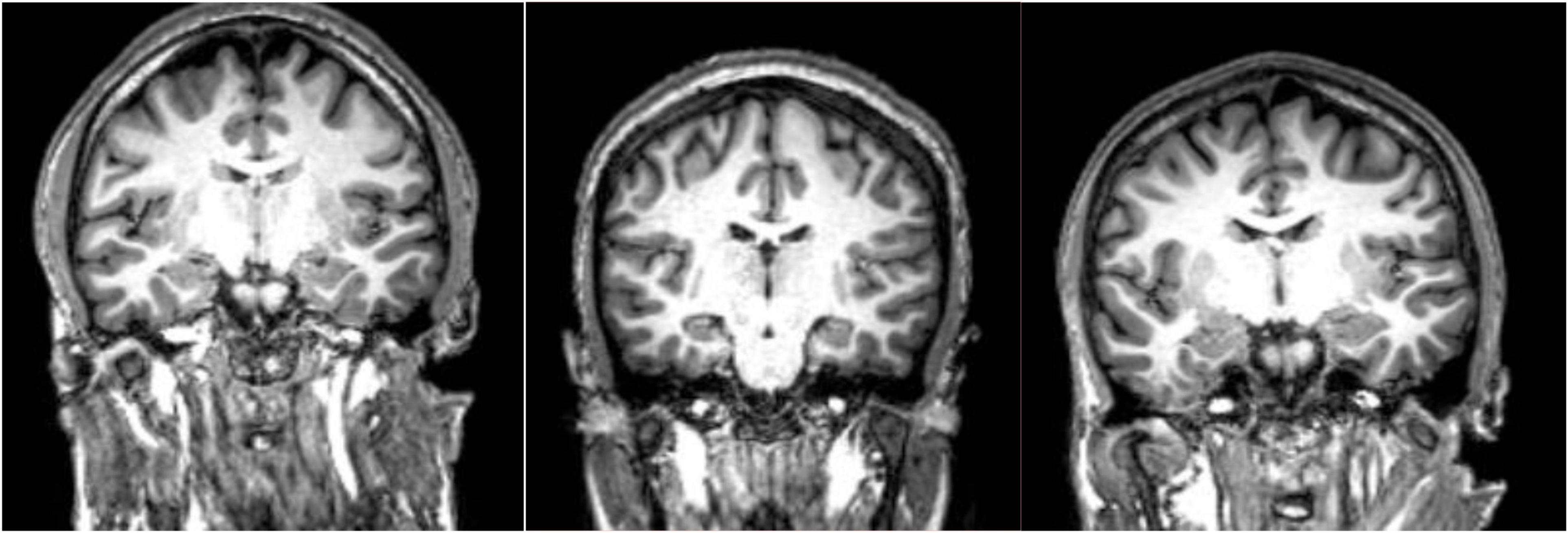 Frontiers | Neuroimaging in schizophrenia: A review article
