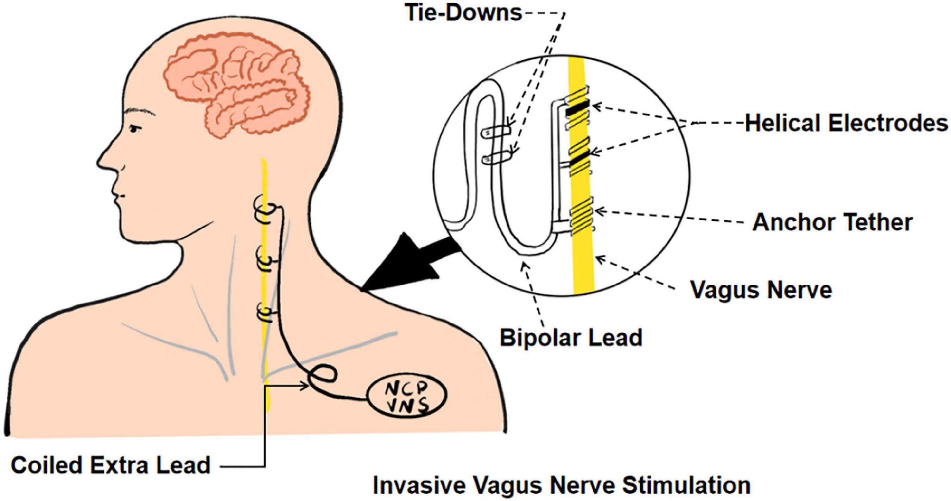 Frontiers Research Advances In The Application Of Vagus Nerve 