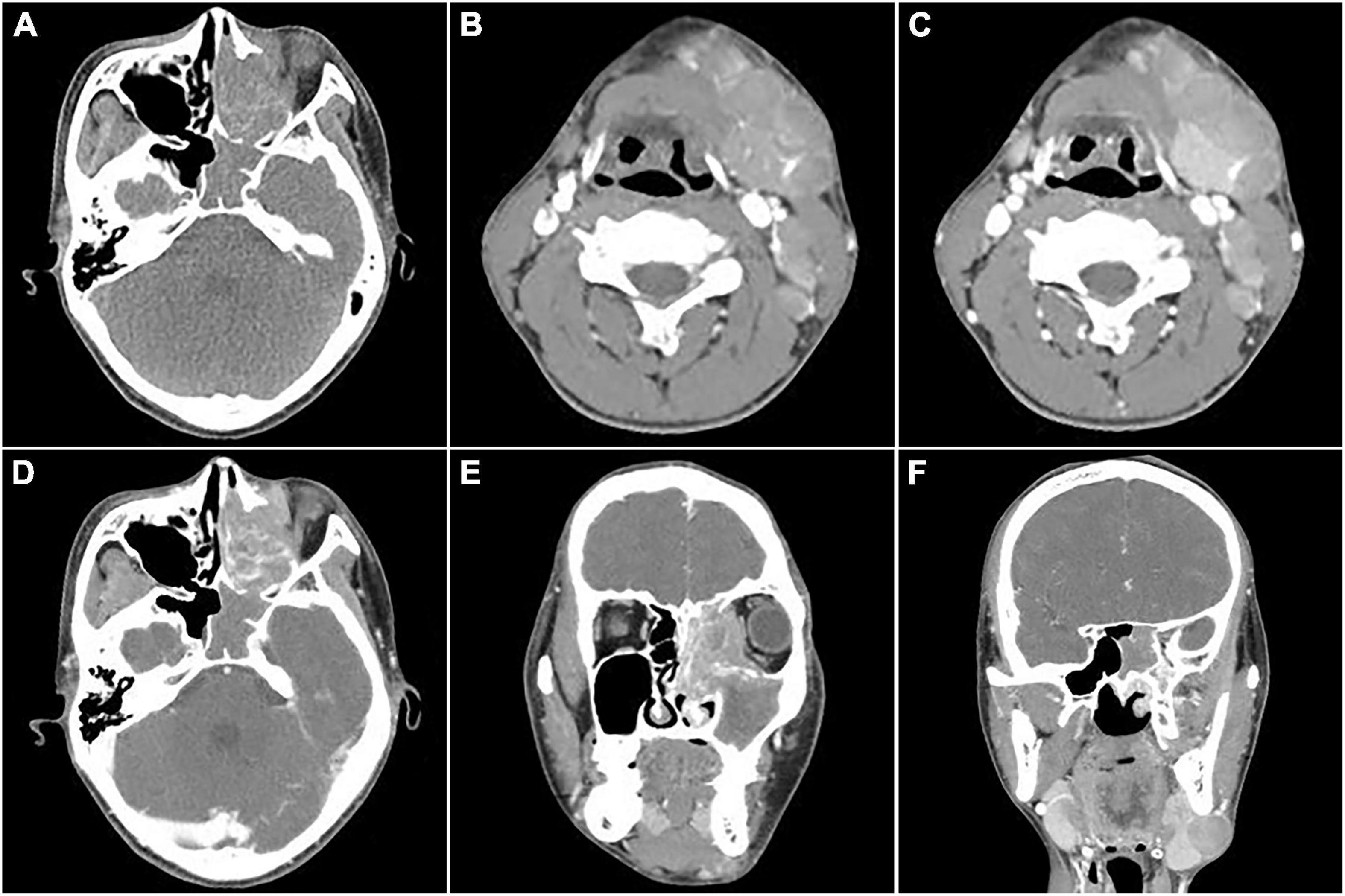 Frontiers Multimodality Imaging Evaluation Of Nasal Sinus Alveolar Rhabdomyosarcoma Two Case 1373