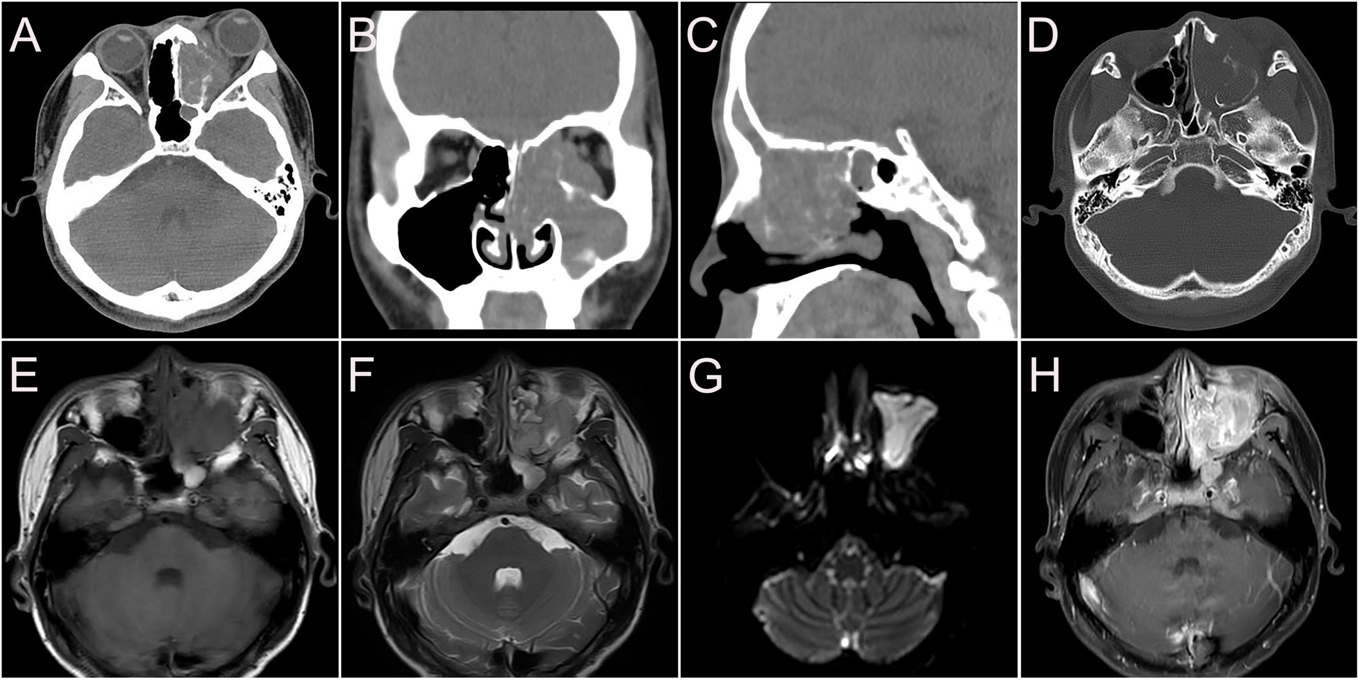 Frontiers Multimodality Imaging Evaluation Of Nasal Sinus Alveolar Rhabdomyosarcoma Two Case 3476